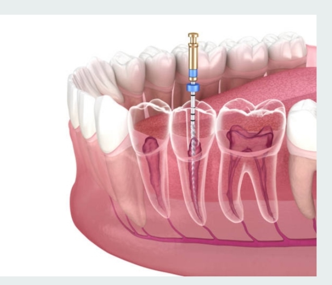 Ilustración detallada de un procedimiento de endodoncia mostrando el interior del diente y el uso de herramientas especializadas, representando los tratamientos avanzados ofrecidos en Granada centro.