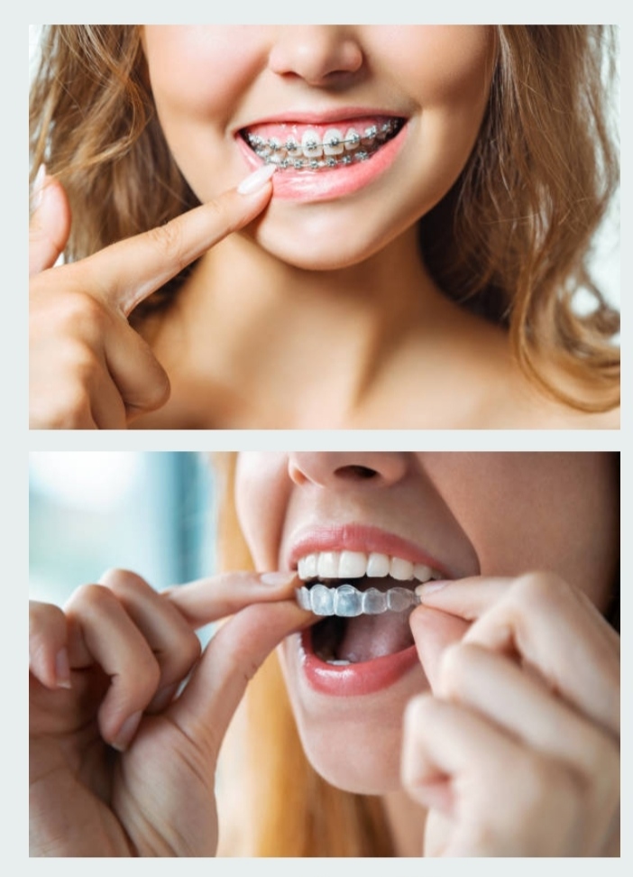 Mujer colocando alineadores transparentes, destacando la estética y comodidad de los tratamientos ortodónticos ofrecidos por un dentista en Granada centro.