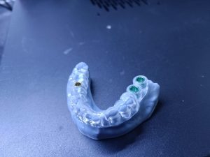 Modelo de guía quirúrgica con perforaciones para implantes dentales, destacando la precisión y tecnología avanzada utilizada por un dentista en Granada centro.