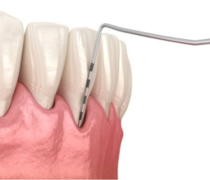 Representación de una sonda periodontal inspeccionando la salud de las encías, destacando la precisión y cuidado en los diagnósticos ofrecidos por un dentista en Granada centro.
