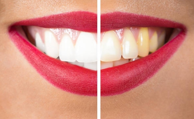 Comparación de dientes antes y después de un tratamiento de blanqueamiento dental, mostrando los beneficios estéticos ofrecidos por un dentista en Granada centro.