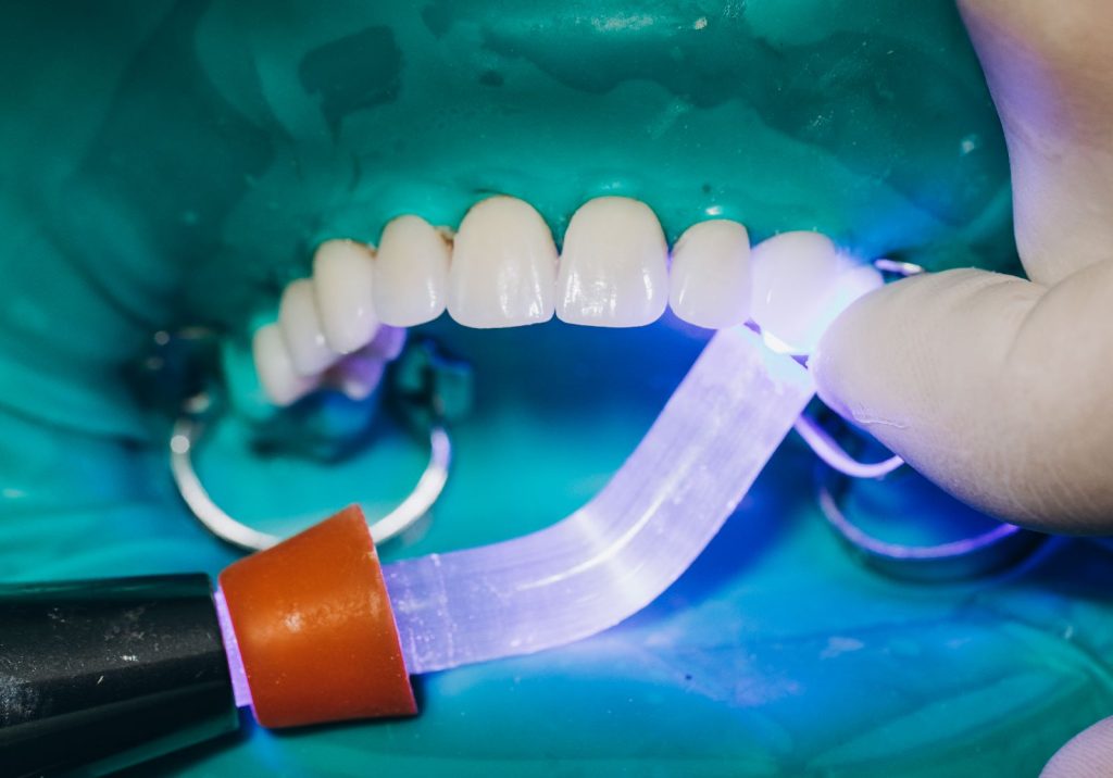 Procedimiento de blanqueamiento dental con luz LED realizado por un profesional, destacando la tecnología moderna utilizada por un dentista en Granada centro.