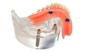 Modelo de prótesis dental superior e inferior sobre implantes, mostrando soluciones avanzadas y personalizadas ofrecidas por un dentista en Granada centro.