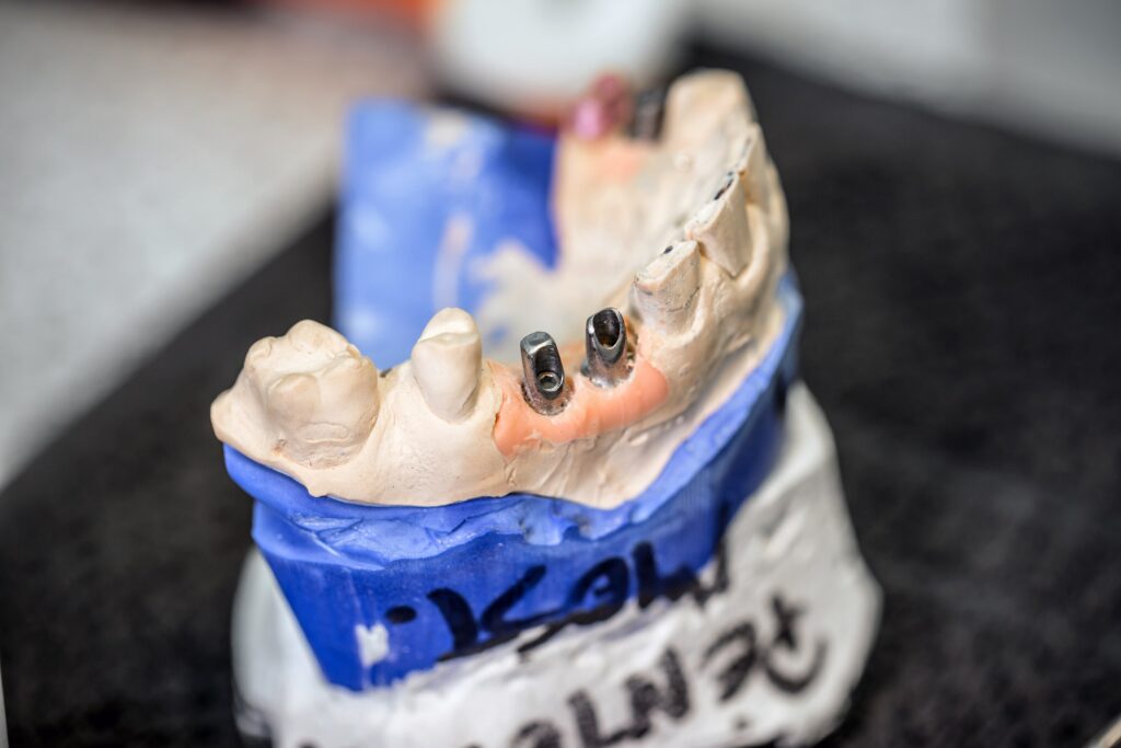 Modelo dental que muestra implantes colocados en la mandíbula, destacando su papel en la mejora de la funcionalidad masticatoria.