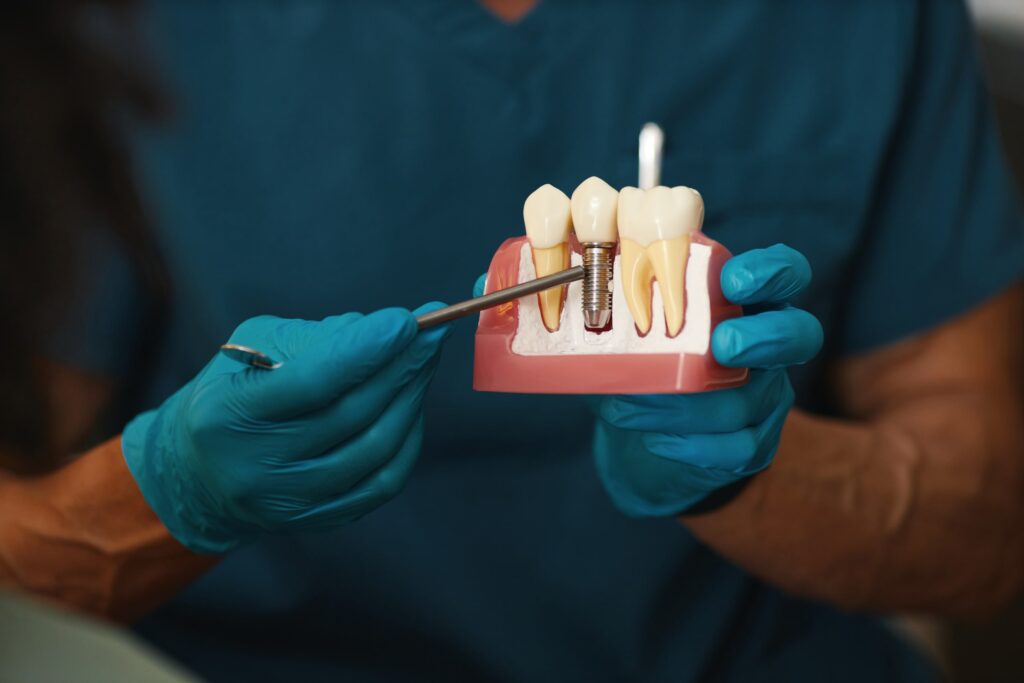 Primer plano de un profesional dental con guantes azules mostrando un modelo de implante dental, ilustrando el procedimiento y estructura. Ideal para información sobre precios de los implantes dentales.
