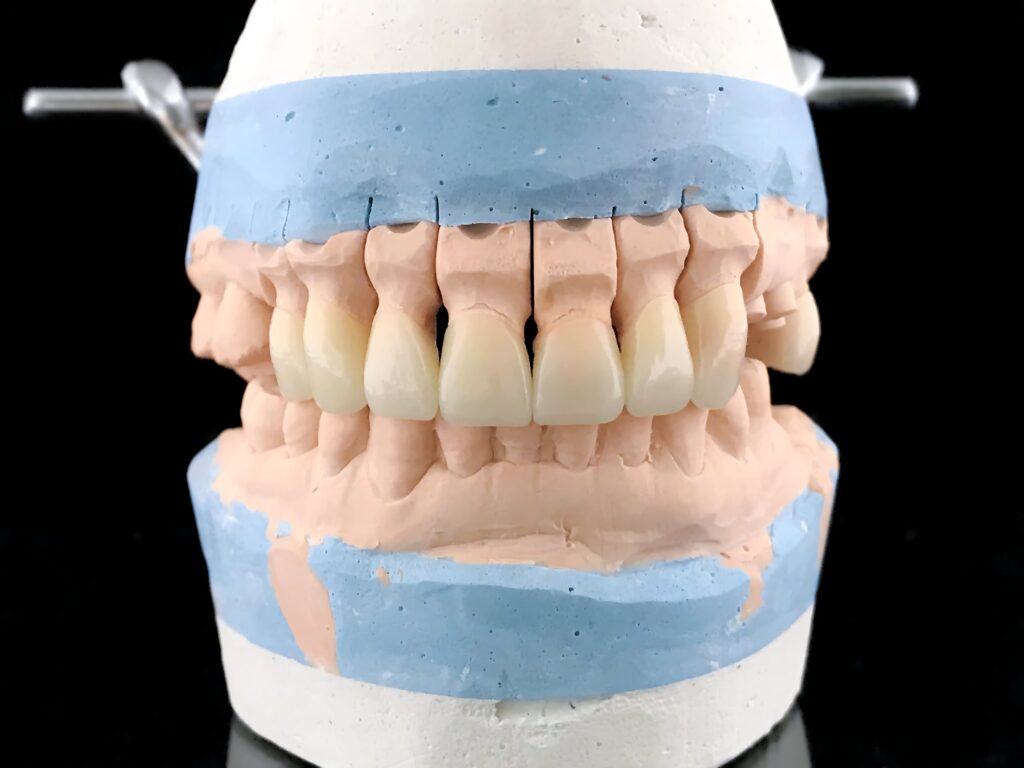 Modelo dental detallado que muestra dientes y encías con implantes de zirconio, destacando su integración con los tejidos para resaltar su biocompatibilidad.