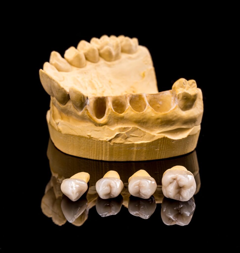 Modelo dental de yeso con cuatro coronas dentales cerámicas removibles al frente, ilustrando la importancia de los cuidados higiénicos en prótesis dentales para mantener la salud bucal y la durabilidad de los implantes.