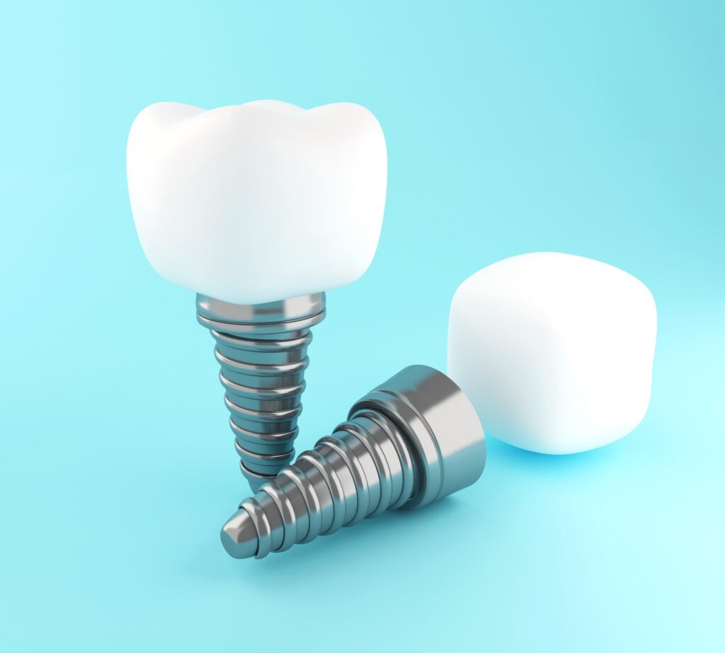 Representación en 3D de un implante dental compuesto por un tornillo metálico y una corona blanca, ideal para explicar preguntas frecuentes sobre implantes dentales.