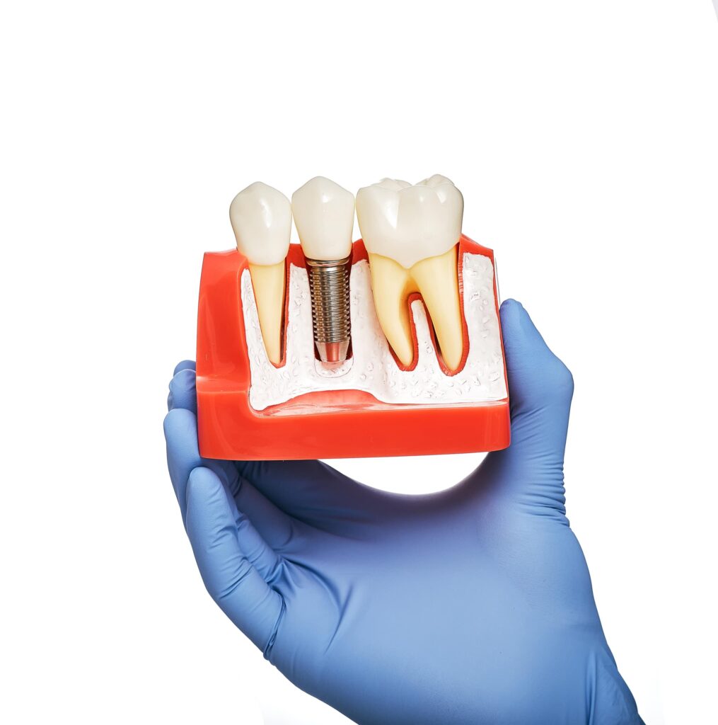 Mano enguantada sosteniendo un modelo anatómico de dientes que muestra un implante dental, destacando la importancia de los cuidados después de la colocación de implantes dentales.