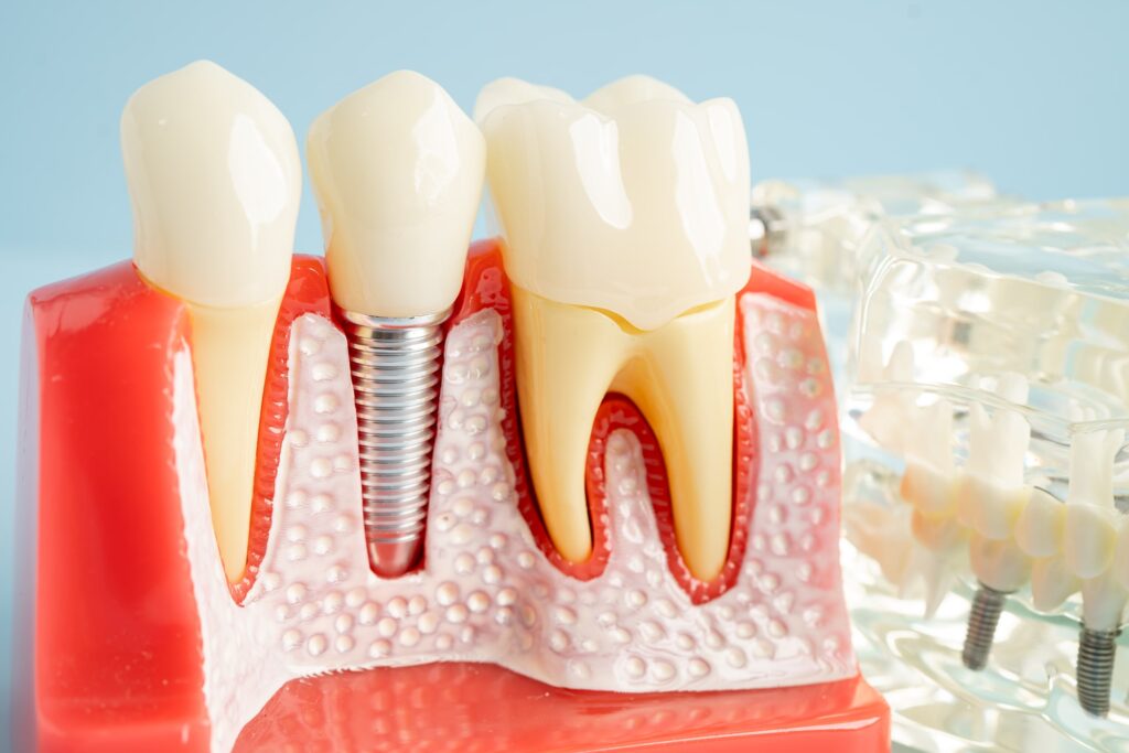 Representación detallada de un modelo de implante dental mostrando su integración en la mandíbula, ideal para proporcionar información adicional y recursos sobre procedimientos odontológicos avanzados.