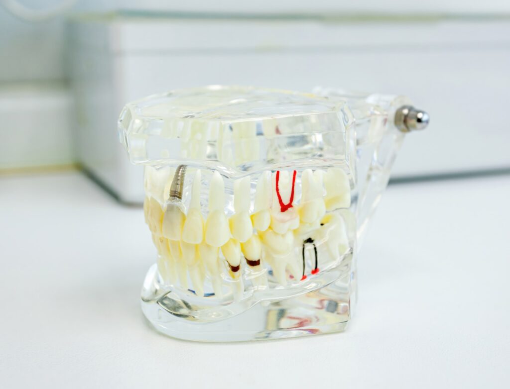 Modelo transparente de mandíbula que muestra un implante dental junto con dientes, encías y hueso, utilizado para explicar soluciones para la pérdida ósea en tratamientos odontológicos.