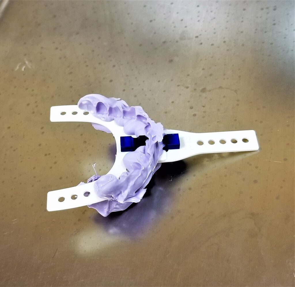 Molde dental de silicona violeta sobre una bandeja metálica, utilizado para el diagnóstico y control de posibles complicaciones tras el recontorneado dental, como sensibilidad o alteraciones en la mordida.