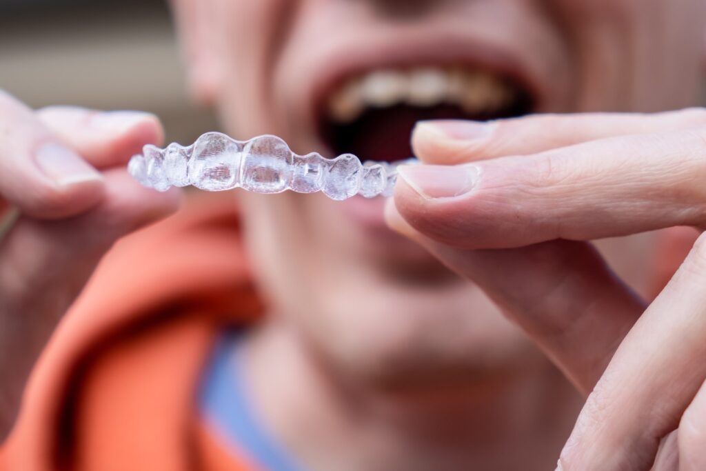 Primer plano de una persona sosteniendo un alineador transparente Invisalign frente a su boca abierta, ilustrando las dudas frecuentes sobre la ortodoncia invisible Invisalign y cómo se colocan estos alineadores.