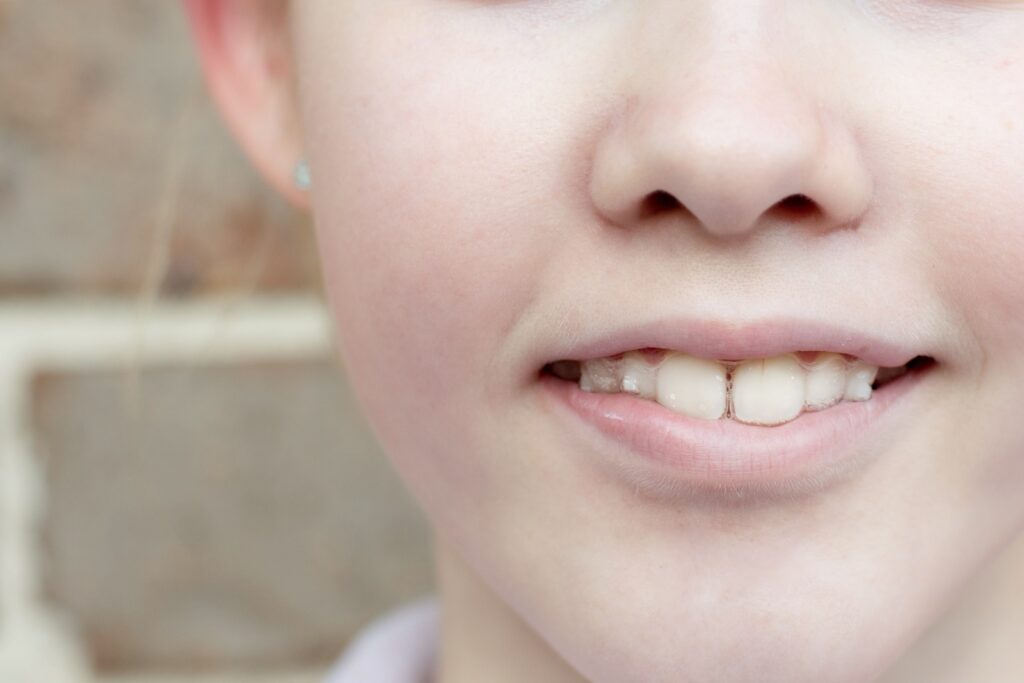 Primer plano de una joven sonriendo y mostrando alineadores transparentes Invisalign en sus dientes, ilustrando el proceso del tratamiento de ortodoncia Invisalign desde su colocación inicial.
