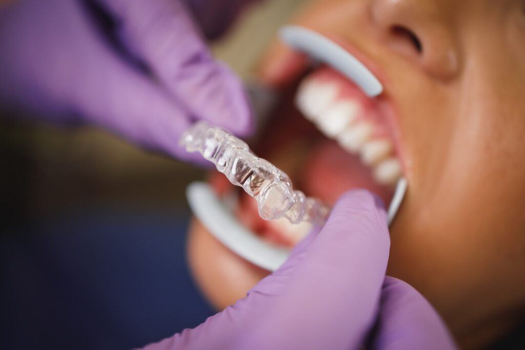 Primer plano de un dentista colocando un alineador transparente Invisalign en la boca de un paciente, representando las opiniones positivas de pacientes sobre la comodidad y eficacia del tratamiento Invisalign.