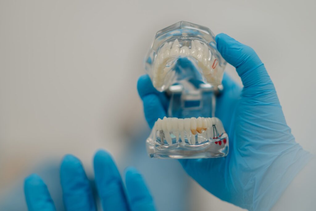 Dentista con guantes azules sosteniendo un modelo dental para explicar los beneficios de los implantes dentales, mostrando cómo mejoran la funcionalidad y estética de la sonrisa.