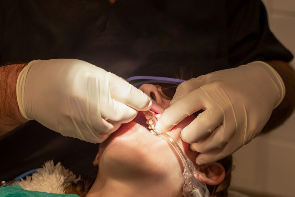 Odontólogo instalando brackets metálicos en los dientes de un paciente infantil, ideal para explicar la comparativa estética y funcional entre brackets metálicos y otras opciones ortodóncicas, resaltando diferencias en visibilidad, durabilidad y efectividad del tratamiento.