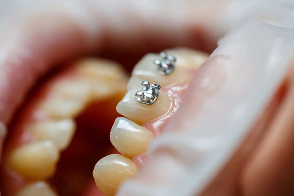 Detalle de dientes de un paciente infantil con recién colocados brackets metálicos, destacando las consideraciones importantes para pacientes infantiles y adolescentes en tratamientos de ortodoncia, como supervisión profesional, adaptación y seguimiento constante para lograr una alineación dental saludable.