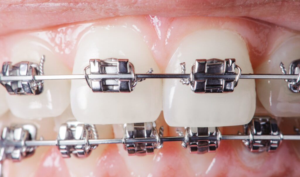 Macro de dientes con brackets metálicos mostrando en detalle su sujeción y estructura, ideal para ilustrar las principales ventajas de los brackets metálicos como su resistencia, precisión en el tratamiento y efectividad para resolver problemas de alineación dental.