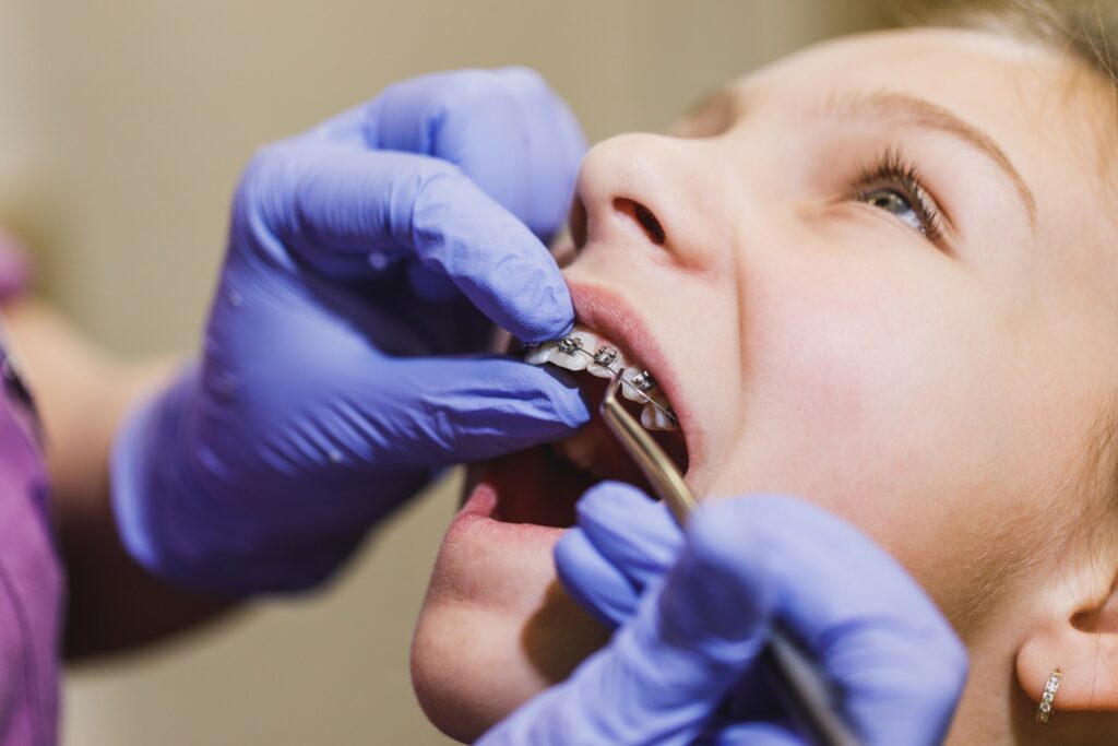 Niña en consulta odontológica mientras un ortodoncista ajusta sus brackets metálicos, representando los diferentes tipos de brackets metálicos y sus aplicaciones para corregir problemas dentales de manera eficiente y personalizada en pacientes jóvenes.