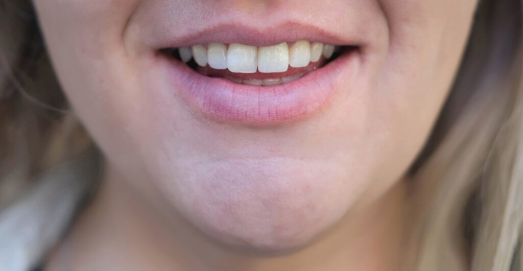 Primer plano de una mujer mostrando su sonrisa después de un tratamiento dental, destacando los beneficios y ventajas de las carillas dentales para lograr dientes blancos, alineados y estéticamente agradables.