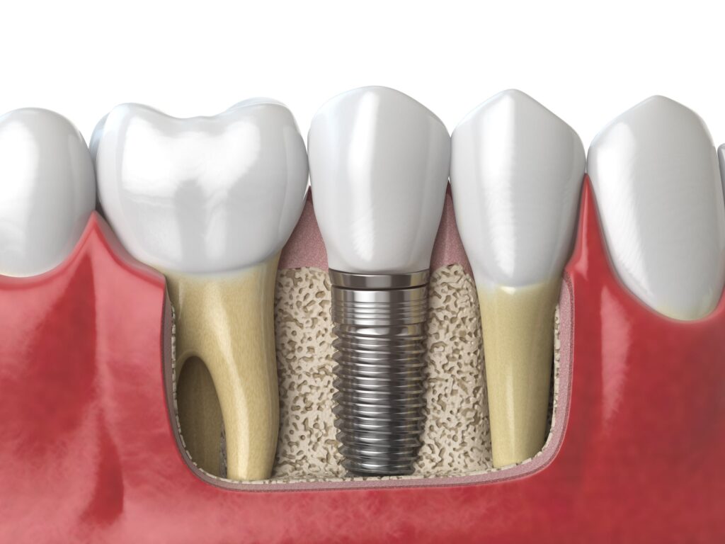 Ilustración anatómica de dientes sanos y un implante de zirconio en la mandíbula, destacando la importancia de los cuidados de los implantes de zirconio para prevenir problemas y asegurar su integración ósea.