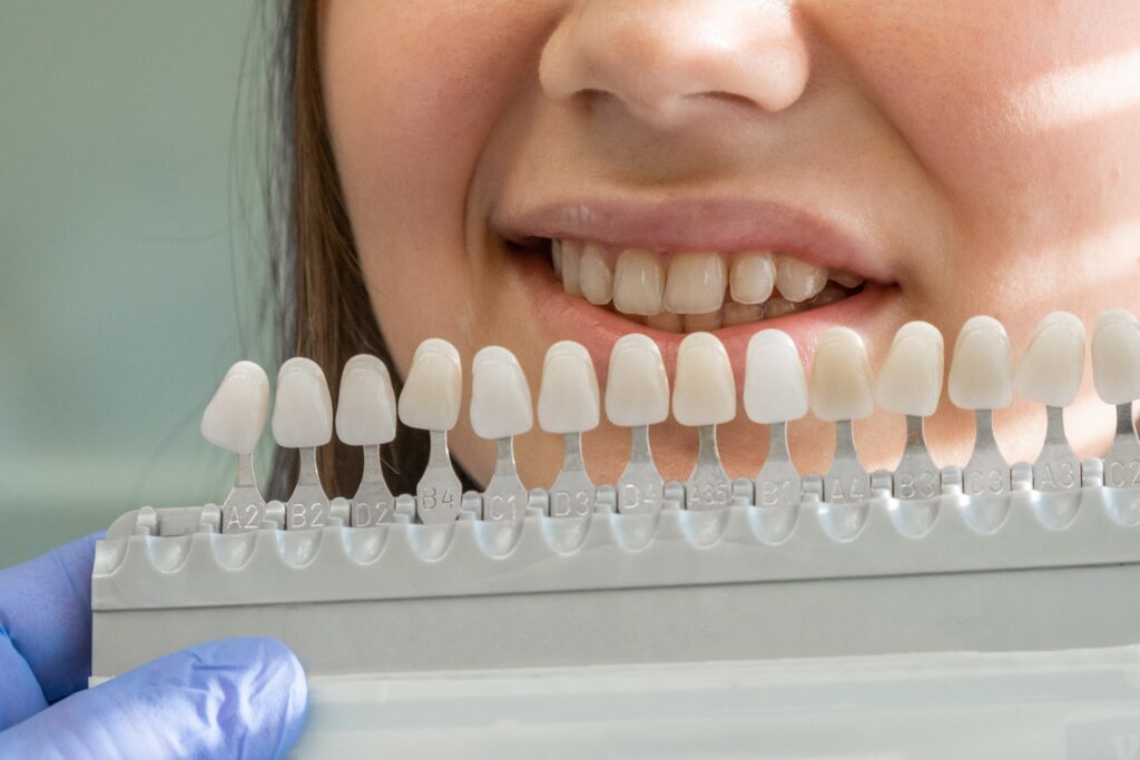 Paciente sonriendo mientras el dentista compara diferentes tonos de carillas dentales frente a sus dientes para explicar el coste de las carillas dentales según el material y el diseño estético elegido.