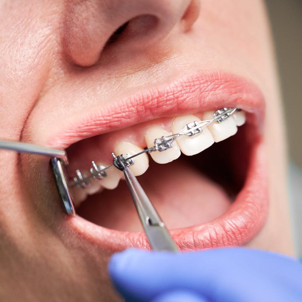 Mujer joven sonriendo y mostrando sus brackets metálicos en los dientes superiores mientras se evalúa la duración del tratamiento con brackets metálicos para alinear su sonrisa.