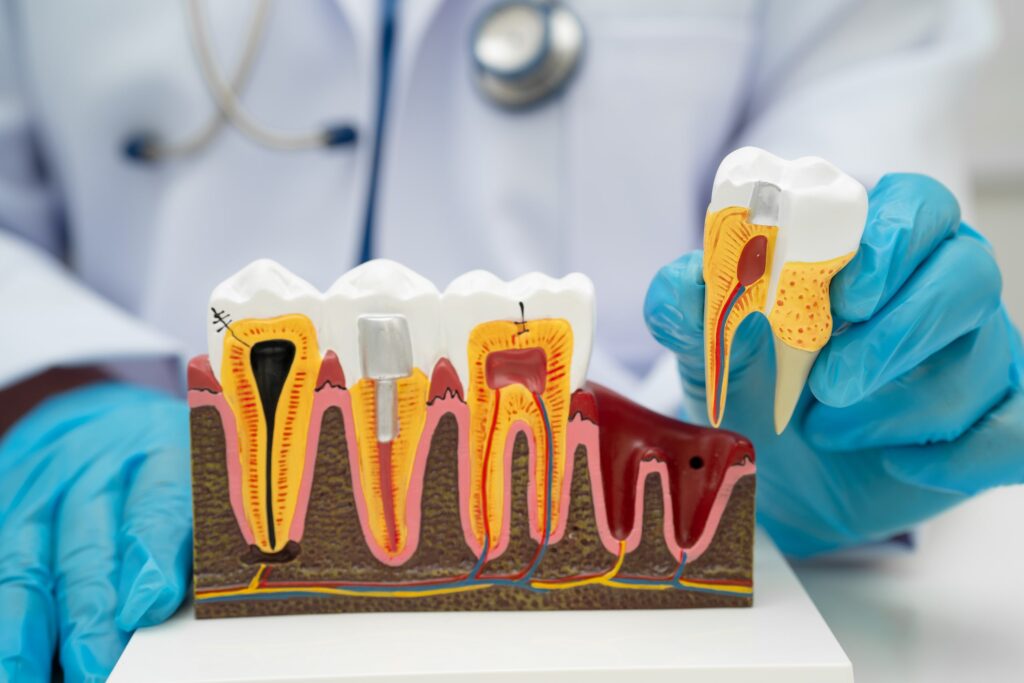 Dentista con guantes azules mostrando un modelo anatómico de dientes e implantes para explicar los tratamientos para la periodontitis y la regeneración del hueso dental.