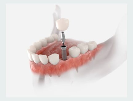 Cirugia oral Representación gráfica de un implante dental con corona, destacando los tratamientos avanzados ofrecidos por un dentista en Granada centro.