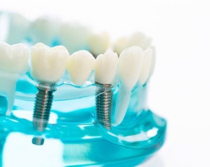 Implantologia Modelo dental con implantes y coronas sobre una base azul transparente, destacando los tratamientos avanzados disponibles en Granada centro.